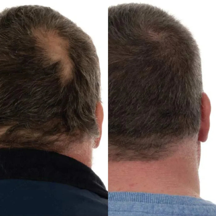 Foligain hair loss shampoo + conditioner men (236 ml) - Hairgivers