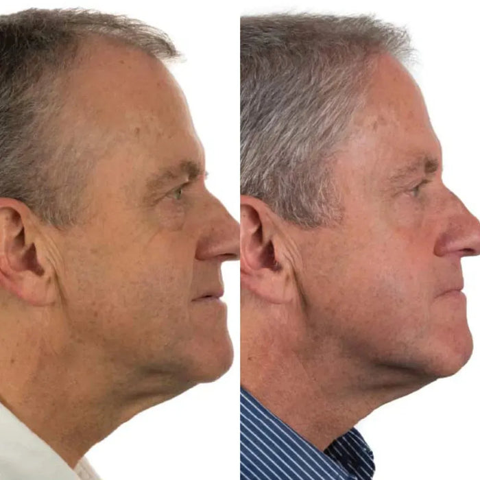 Foligain hair growth treatment (men) - Hairgivers
