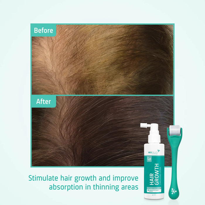 Neofollics Lotion + Scalp Roller