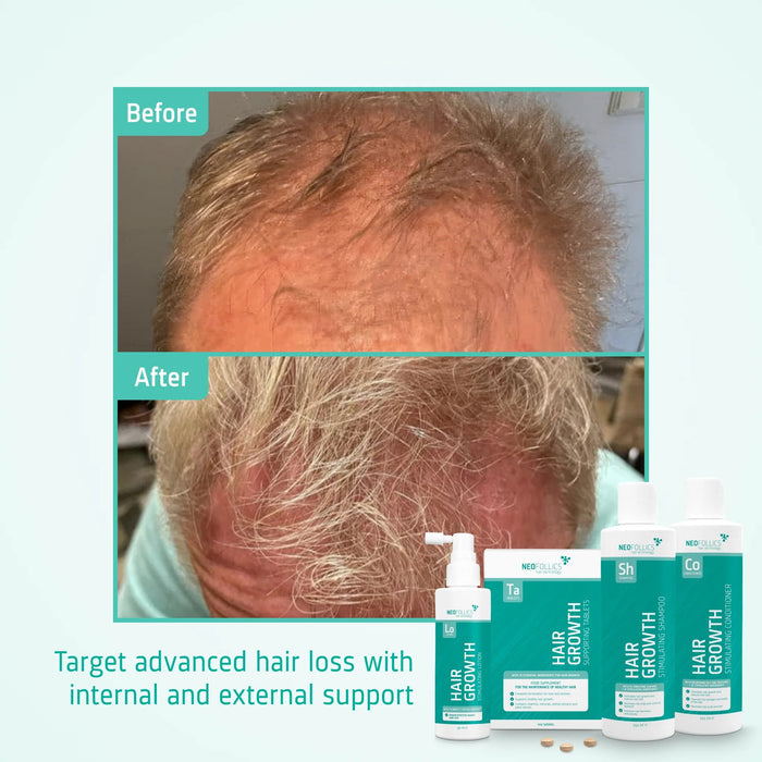 Neofollics Shampoo + Conditioner + Serum + Tablets