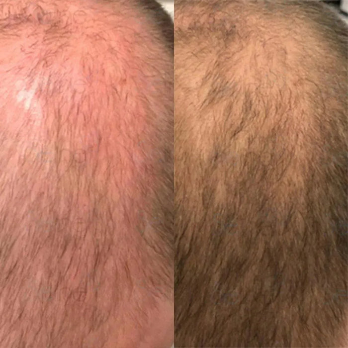 Panthrix hair growth serum (Redensyl) - Hairgivers